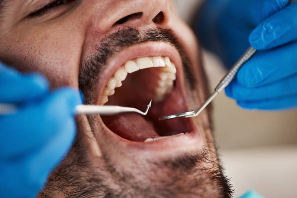Best Emergency Wisdom Tooth Extraction in Brownwood, TX